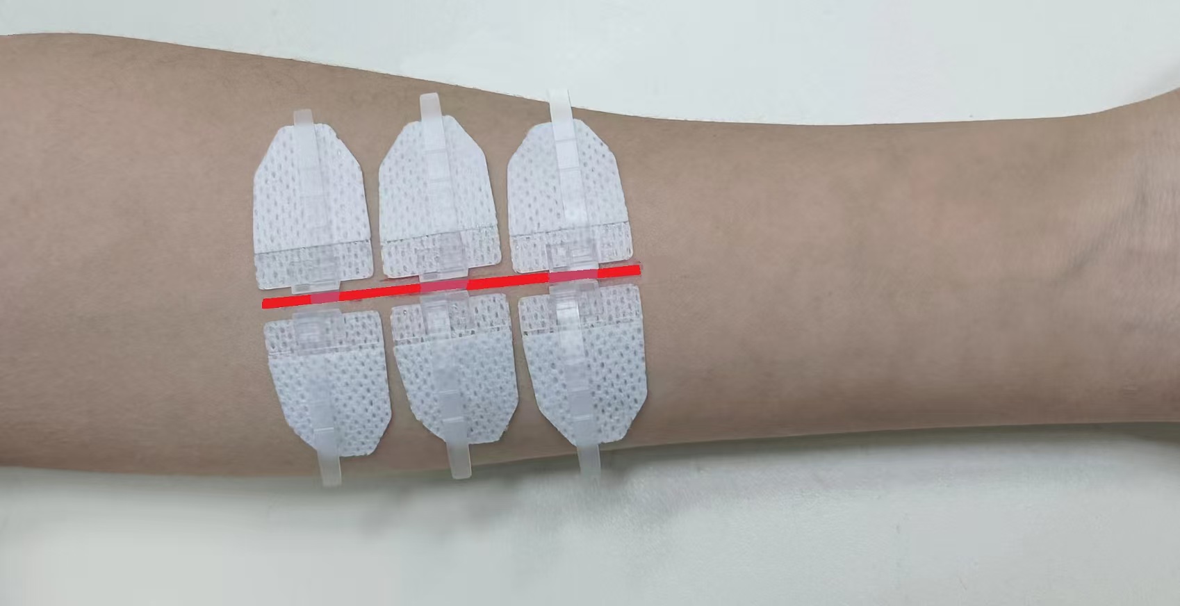 一次性拉扣式皮膚縫合器